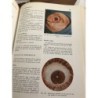 OFTALMOLOGIA-GLAUCOMAS HIPERTENSIONES OCULARES. SIMON, J.M.A-AÑO 1973.